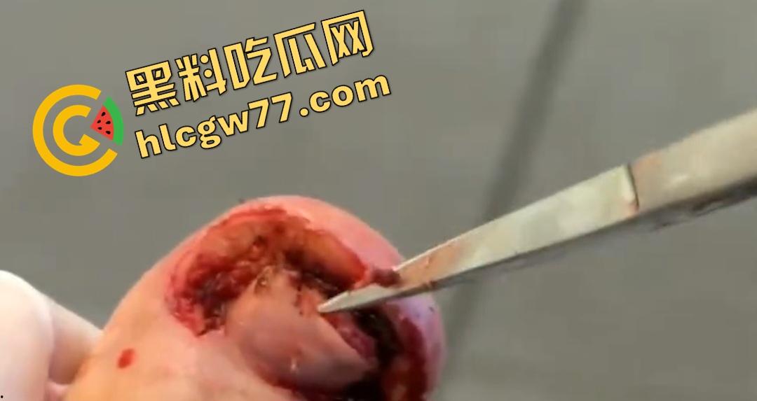 患者天天啃脚指甲狂得甲沟炎!帕尔米耶里手术刀下血肉狂飙,操刀医生差点呕吐!-4