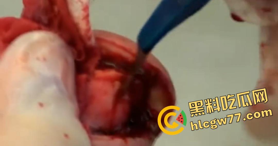 患者天天啃脚指甲狂得甲沟炎!帕尔米耶里手术刀下血肉狂飙,操刀医生差点呕吐!-6