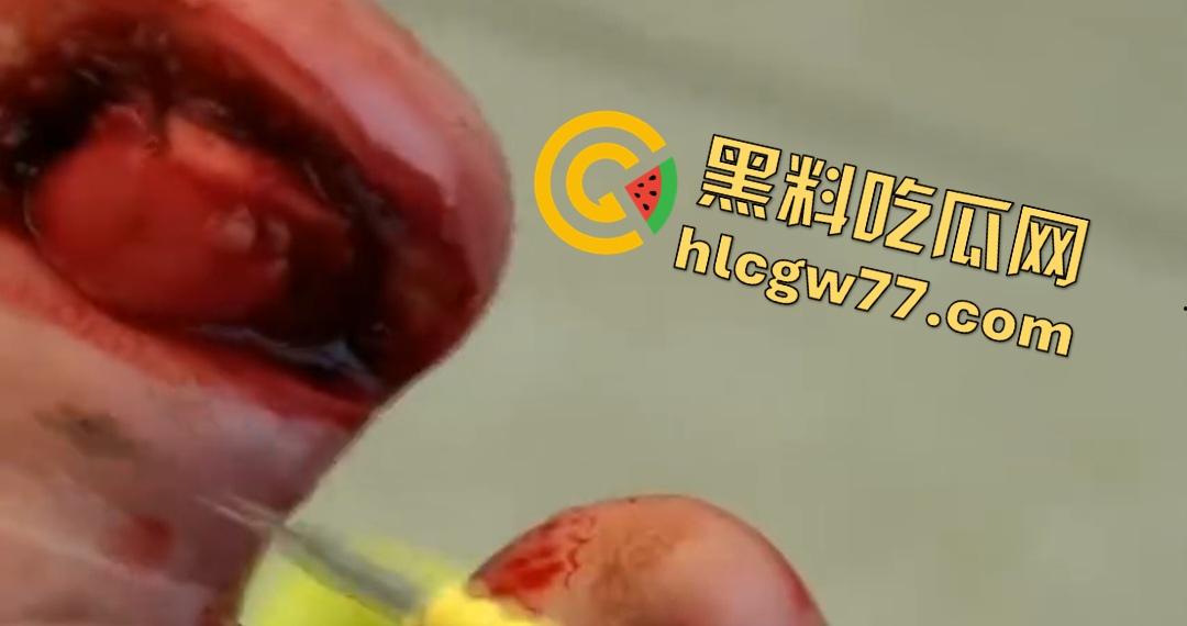 患者天天啃脚指甲狂得甲沟炎!帕尔米耶里手术刀下血肉狂飙,操刀医生差点呕吐!-8
