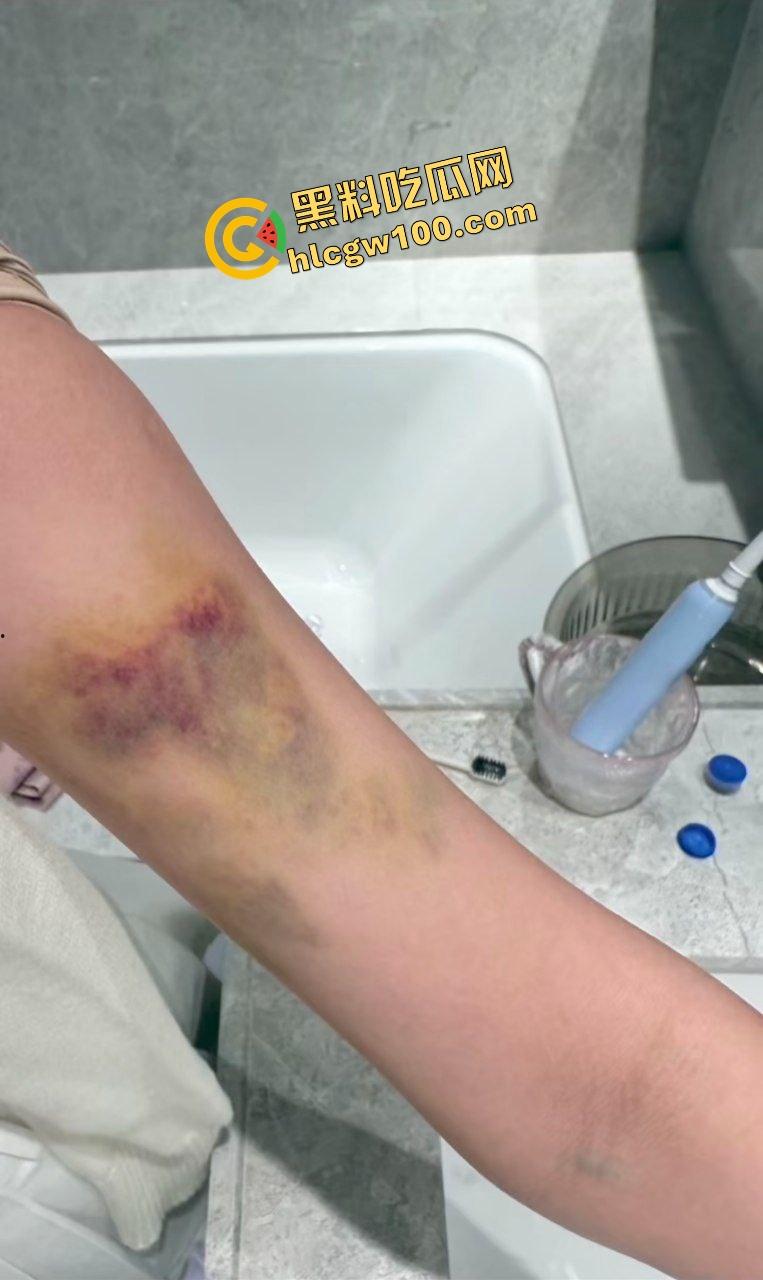 街球圈情侣大瓜!杭州街球手【程鑫凯】家暴女网红【鸡腿诺】多处打伤哭泣现场!独家开盒流出!-17